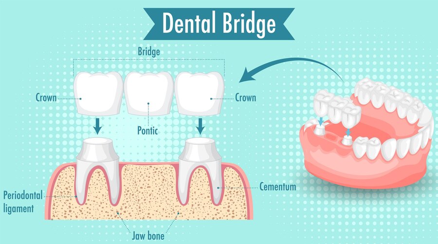 Dental Crowns and Bridges (Tooth Caps) in Pune